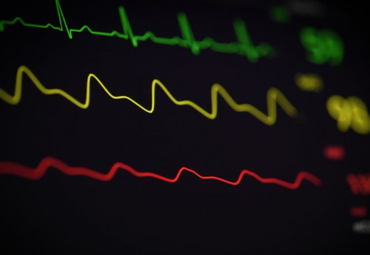 a close up of a computer screen with a line of ecg