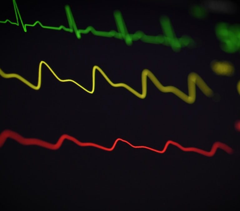 a close up of a computer screen with a line of ecg